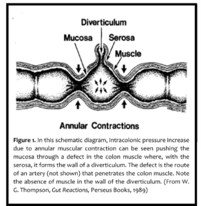 diverticulitis